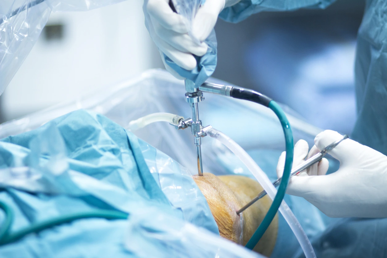 Artroscopia de rodilla en Tijuana — Dr. Romario Perea